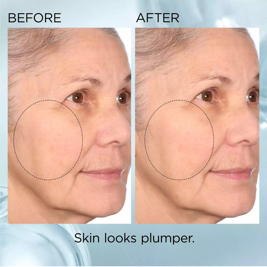 Before and After- Skin looks plumper